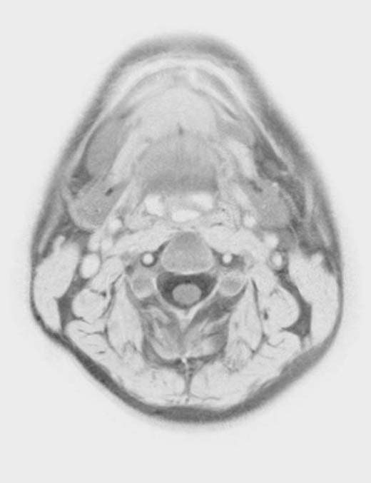 deep spaces of head & neck