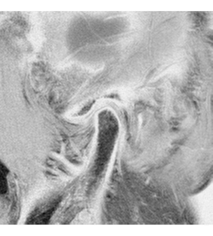 temporomandibular joint